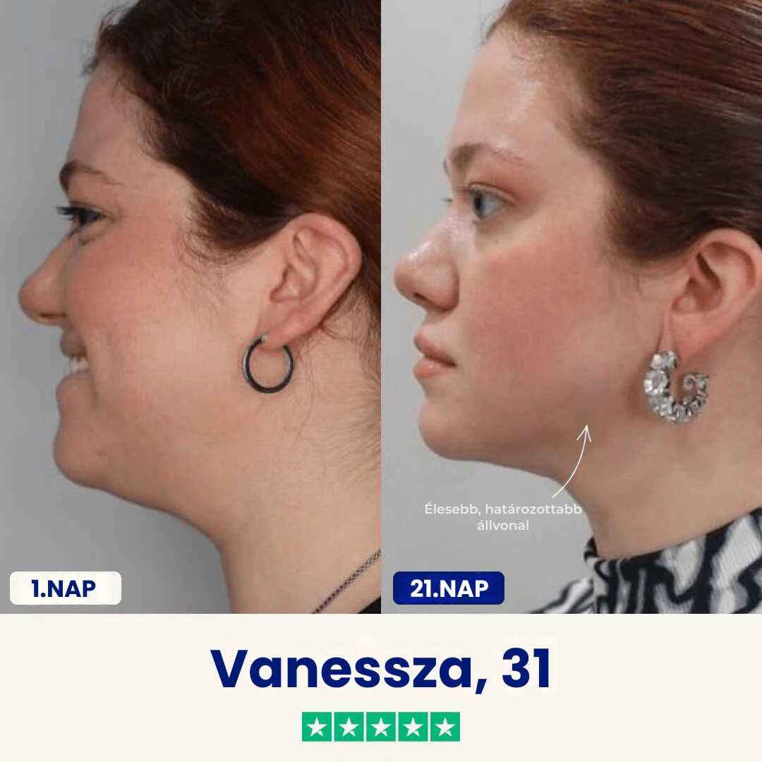 Chinology™ Áll Formáló Maszk